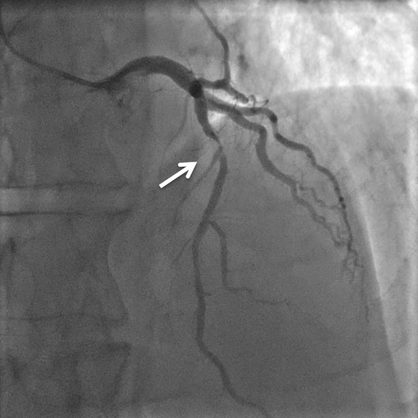 coronarography-stenosis