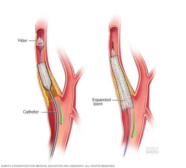 mcdc7_carotid_stenting-8col